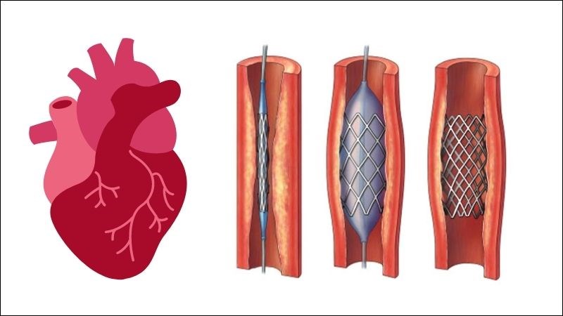 Nong mạch vành giúp làm rộng đoạn mạch máu bị hẹp để máu lưu thông dễ hơn