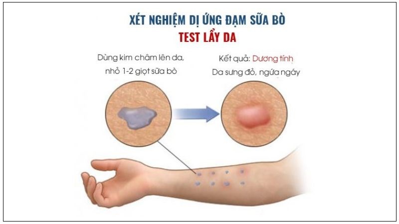 4. Phương pháp điều trị dị ứng đạm sữa bò