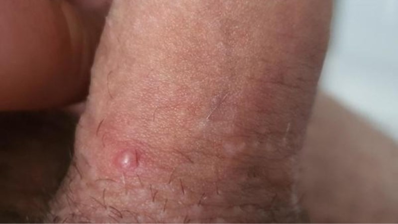 Cạo lông vùng kín là nguyên nhân phổ biến gây nổi mụn ở dương vật