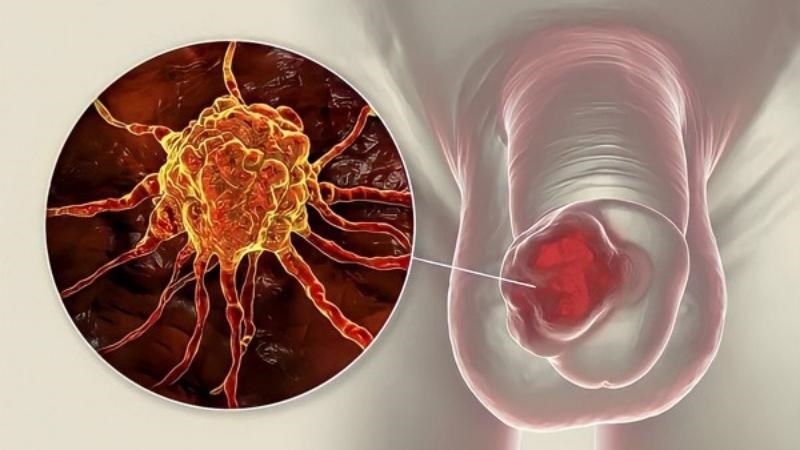 Nổi mụn ở dương vật còn là dấu hiệu của nhiều bệnh lý như ung thư dương vật