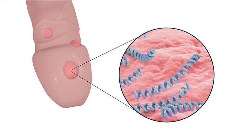 Giang mai ở dương vật cũng làm xuất hiện những nốt mụn nước