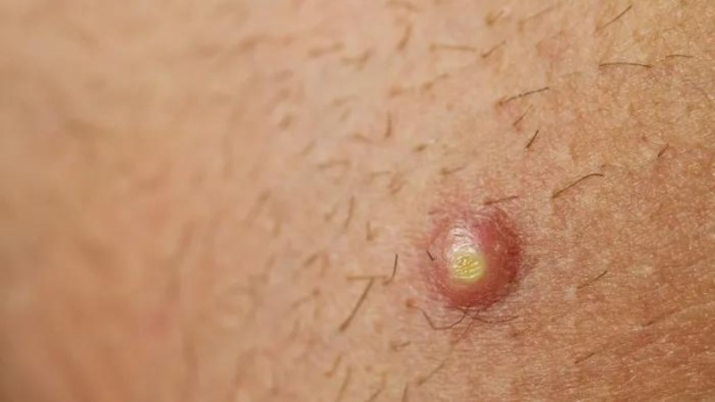 Tuyệt đối không được tự ý nặn mụn để tránh mụn lây lan sang vùng da lành khác