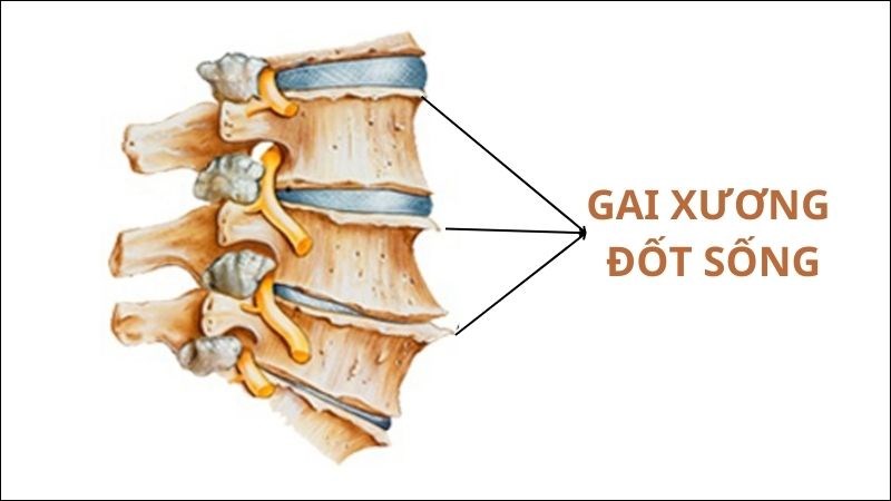 Gai xương là phần xương thừa mọc ra ở đầu xương