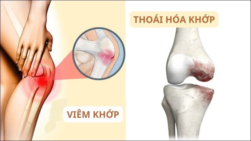 Viêm khớp và thoái hóa khớp là hai nguyên nhân hàng đầu gây gai xương