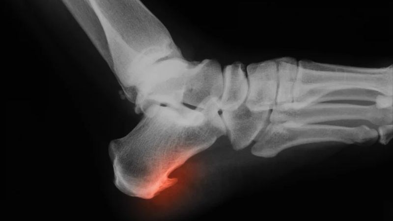 Gai gót chân gây đau ở mặt dưới gót chân khi đi lại