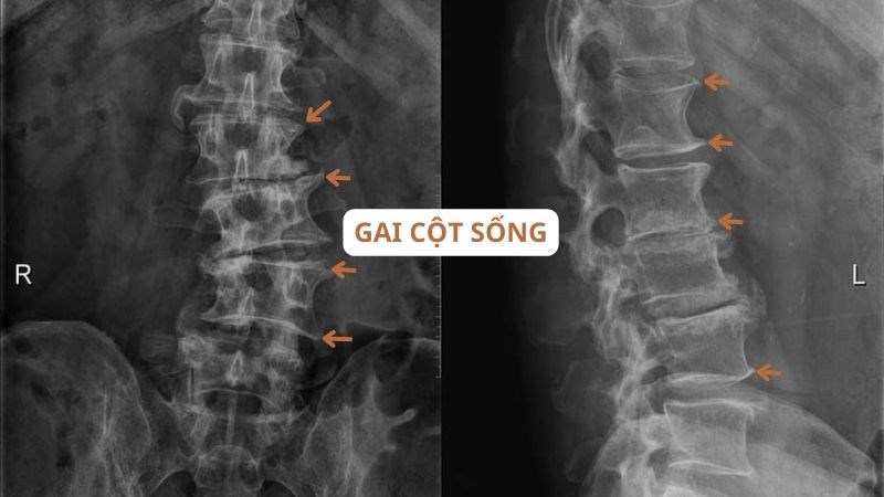 Chụp X-quang là phương pháp đơn giản, chính xác và rẻ tiền nhất để chẩn đoán gai xương
