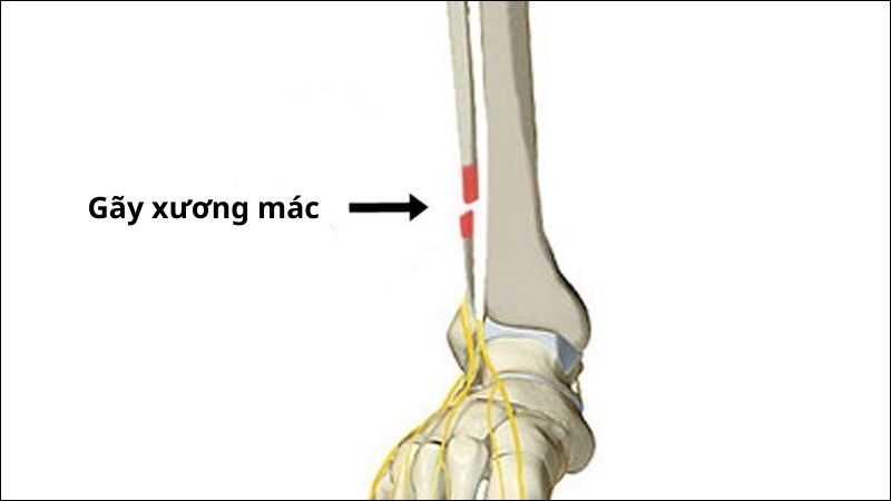 7. Phòng ngừa gãy xương mác