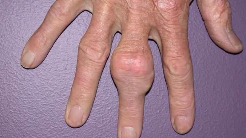 Hạt tophi là tập hợp các tinh thể mononatri urat lắng đọng ở các mô