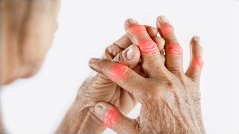 Bệnh gout là nguyên nhân chính dẫn đến hình thành hạt tophi