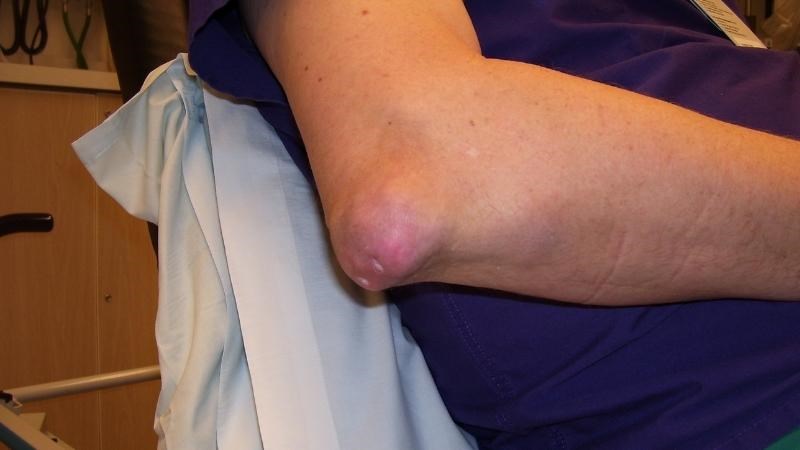 Dấu hiệu của hạt tophi bị viêm là sưng tấy, phù nề vị trí khớp có hạt tophi