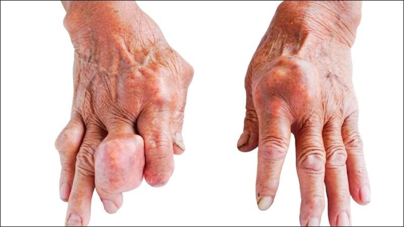 Để chẩn đoán hạt tophi, bác sĩ thường dựa vào triệu chứng lâm sàng của bệnh nhân là chính