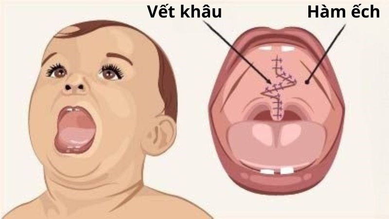 Phẫu thuật hở hàm ếch giúp đóng kín khe hở giữa mũi và miệng Phẫu thuật hở hàm ếch giúp đóng kín khe hở giữa mũi và miệng