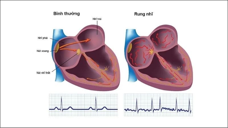 Rung nhĩ là biến chứng phổ biến của hở van tim hai lá