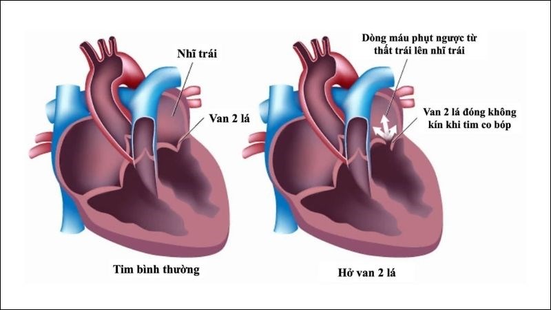 Hở van tim 2 lá là tình trạng không đóng khít của van 2 lá
