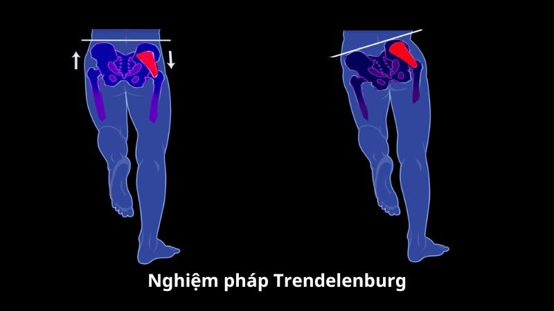 Bệnh nhân có hội chứng mông chết thường dương tính với nghiệm pháp Trendelenburg Bệnh nhân có hội chứng mông chết thường dương tính với nghiệm pháp Trendelenburg