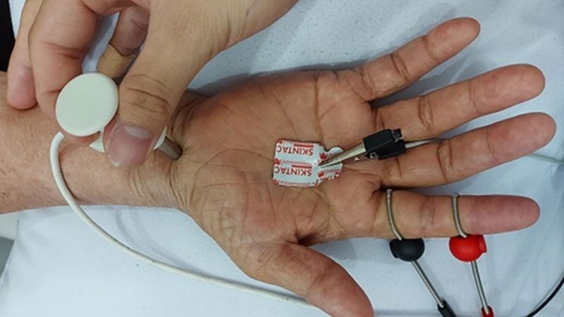 Phương pháp điện cơ (EMG) và nghiên cứu dẫn truyền thần kinh