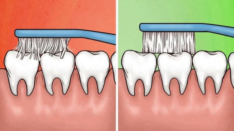 Vệ sinh răng miệng kém không loại bỏ được mảng bám Vệ sinh răng miệng kém không loại bỏ được mảng bám