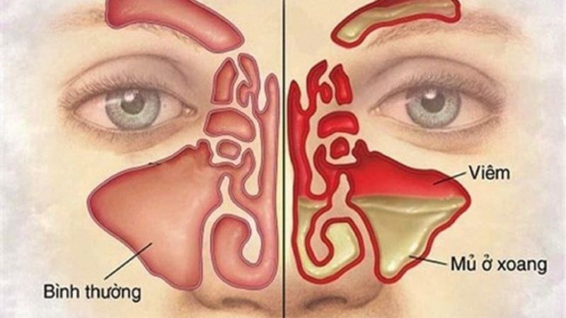 Tình trạng viêm xoang mạn tính có thể gây ra hôi miệng Tình trạng viêm xoang mạn tính có thể gây ra hôi miệng