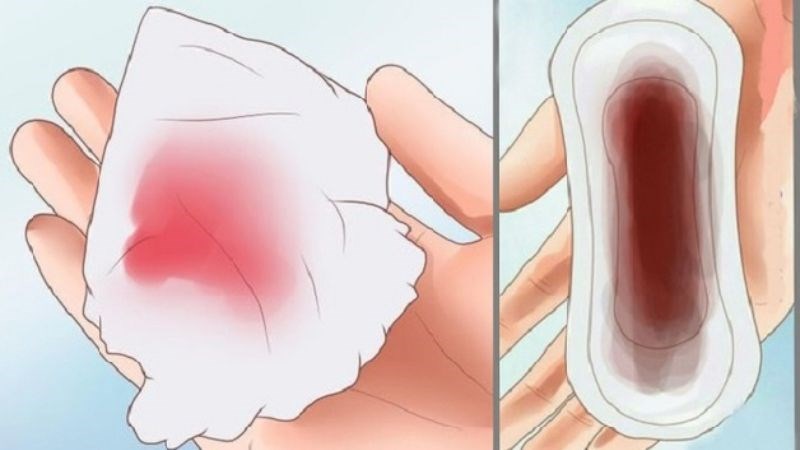 Khí hư có máu, mủ là dấu hiệu của viêm nhiễm 