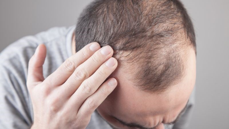Rụng tóc có thể là biểu hiện của mãn dục ở nam giới Rụng tóc có thể là biểu hiện của mãn dục ở nam giới