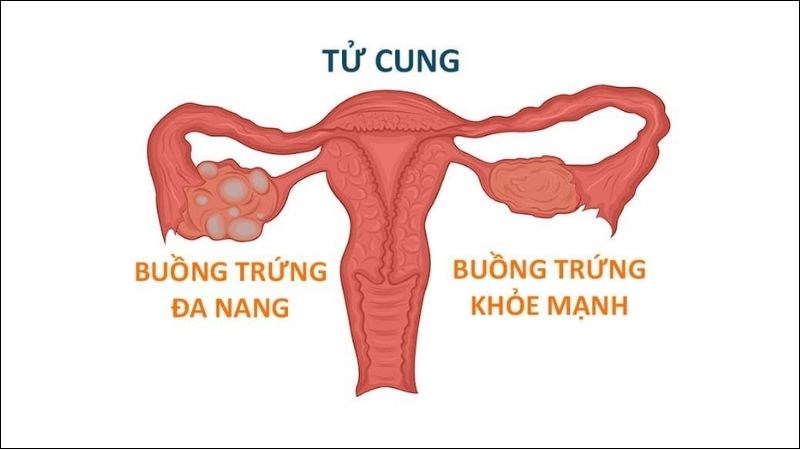 Hội chứng đa nang buồng trứng (PCOS) có thể gây vô kinh Hội chứng đa nang buồng trứng (PCOS) có thể gây vô kinh