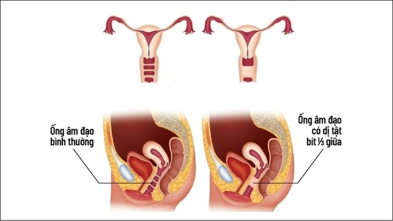 Dị tật đường sinh dục là một trong những nguyên nhân dẫn đến vô kinh Dị tật đường sinh dục là một trong những nguyên nhân dẫn đến vô kinh