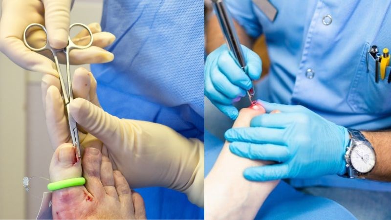Tiểu phẫu loại bỏ móng quặp có thể được áp dụng đối với giai đoạn nặng