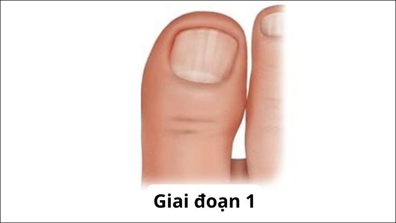 Móng quặp giai đoạn 1 thì cảm giác đau chỉ xuất hiện khi tác động vào