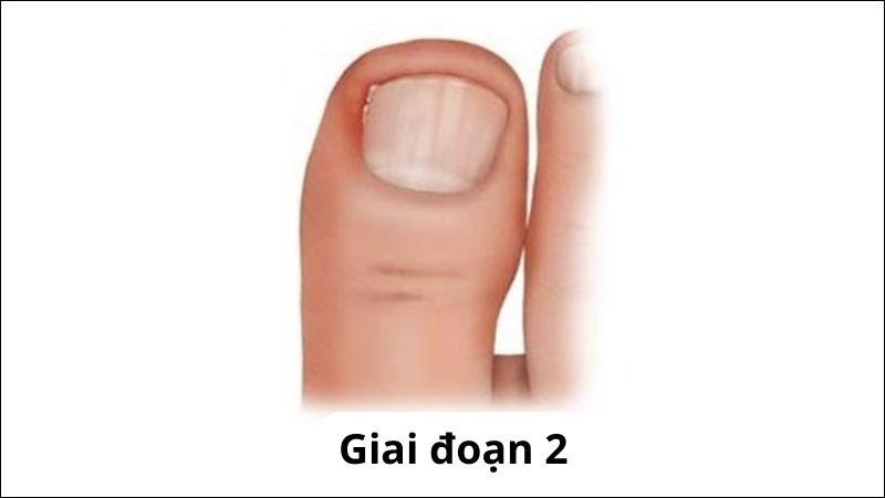 Phần móng viêm ở giai đoạn 2 xuất hiện mủ và mùi hôi nồng
