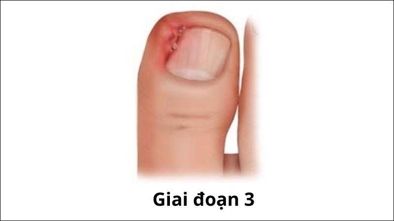 Móng quặp ở giai đoạn 3 nếu không được điều trị có thể gây viêm nhiễm xương