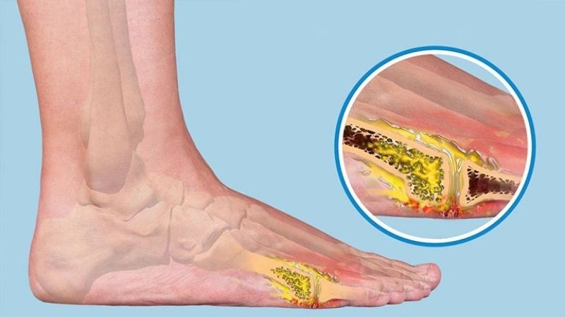 Biến chứng nhiễm trùng xương nghiêm trọng có thể phải dẫn đến cắt bỏ xương 