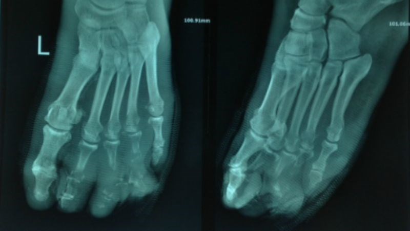 Chụp X-quang có thể được tiến hành khi nghi ngờ nhiễm trùng ăn vào xương