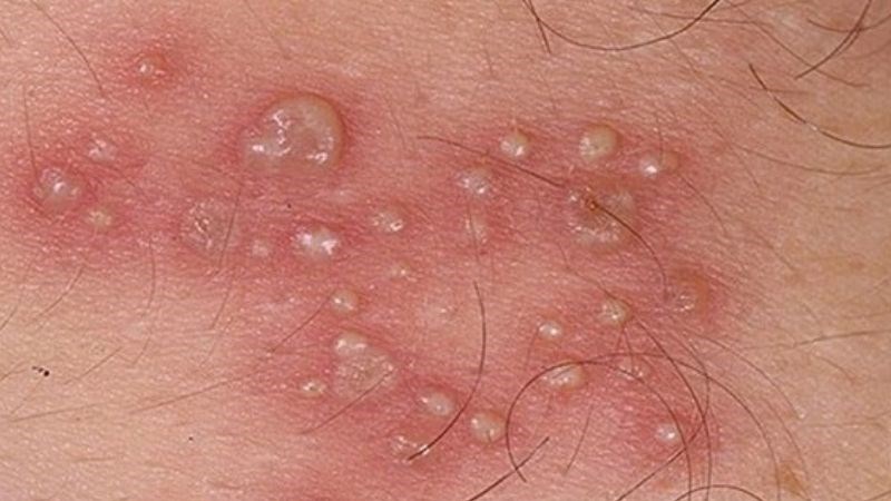 Mụn ở tinh hoàn có thể nghiêm trọng hơn nếu không biết cách xử lý và vệ sinh