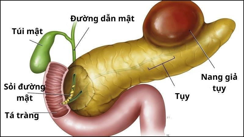 Nang giả tụy là một lớp mỏng chứa dịch tụy, dịch rỉ viêm, máu