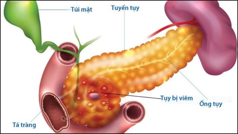 Viêm tụy là nguyên nhân hay gặp nhất gây ra nang giả tụy