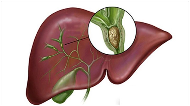 Nang giả tụy có thể gây nên biến chứng tắc nghẽn ống mật chủ