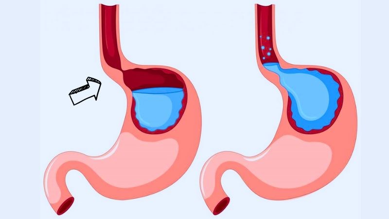 Rối loạn hoạt động cơ vòng thực quản là nguyên nhân chính gây ợ nóng