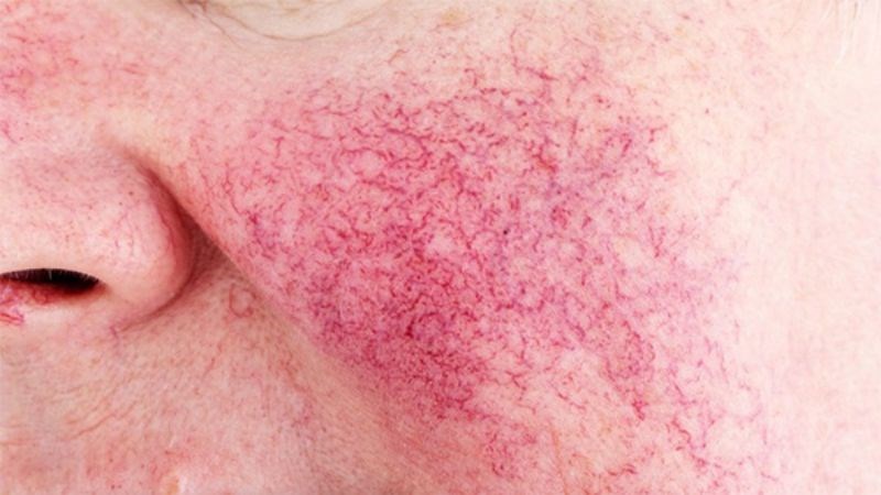 Bệnh do nhiệt độ kích ứng gây đỏ mặt