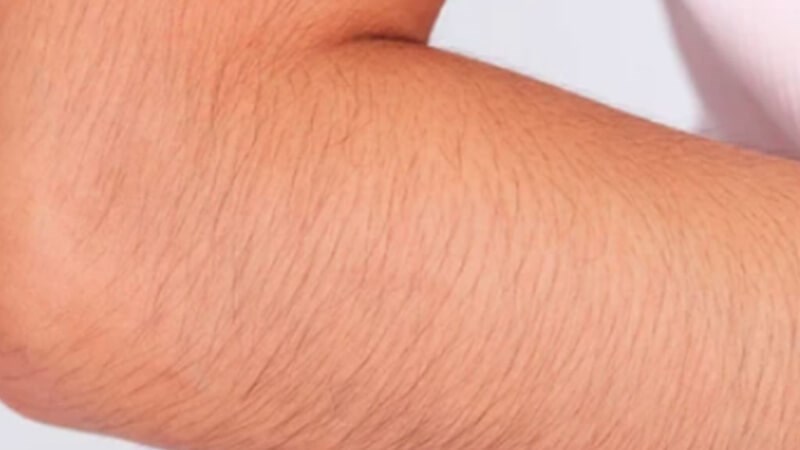 Chứng rậm lông là tình trạng lông tóc phát triển quá mức