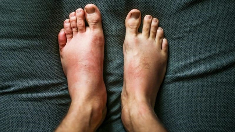 Phù chân là dấu hiệu cảnh báo điều gì? Cách giảm phù hiệu quả