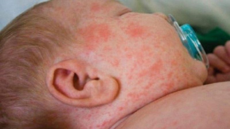 Trẻ sơ sinh sốt thường xuất hiện li bì