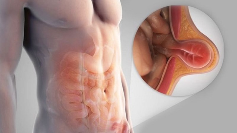 Khi một phần ruột hoặc màng lót khoang bụng chui vào ống bẹn gây nên thoát vị bẹn Khi một phần ruột hoặc màng lót khoang bụng chui vào ống bẹn gây nên thoát vị bẹn