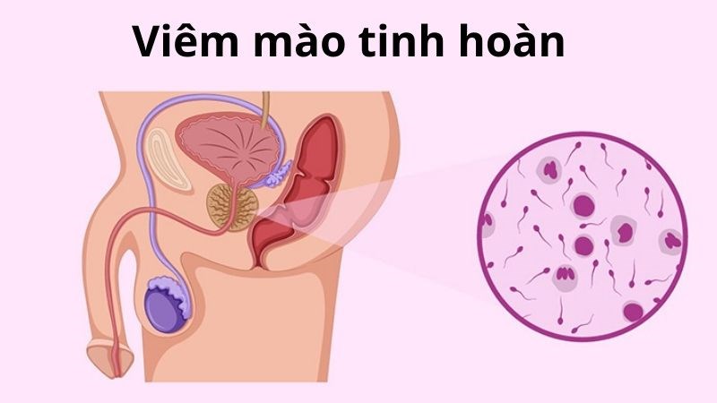 Viêm mào tinh hoàn có thể ảnh hưởng đến cấu trúc tinh trùng