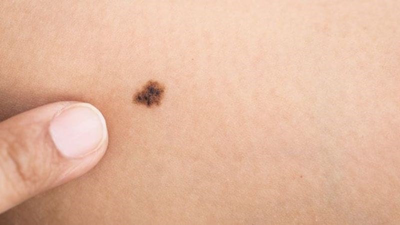 Biến chứng nghiêm trọng của bệnh có thể làm tăng nguy cơ ung thư da 