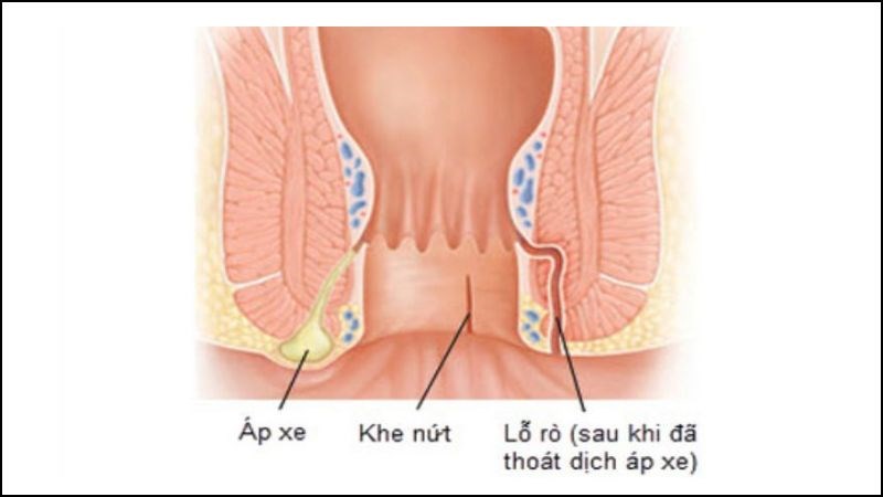 Áp xe hình thành khi vi khuẩn hoặc phân bị mắc kẹt bên trong một trong những tuyến này và bị nhiễm trùng Áp xe hình thành khi vi khuẩn hoặc phân bị mắc kẹt bên trong một trong những tuyến này và bị nhiễm trùng