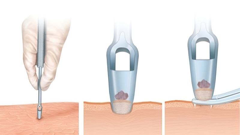 Sinh thiết da là lấy mẫu một phần nhỏ da để kiểm tra tế bào và cấu trúc da