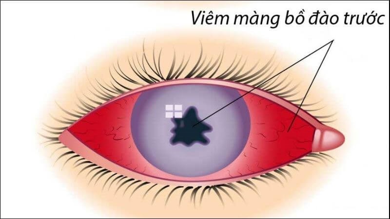 Giun đũa chó mèo có thể gây nên tình trạng viêm màng bồ đào