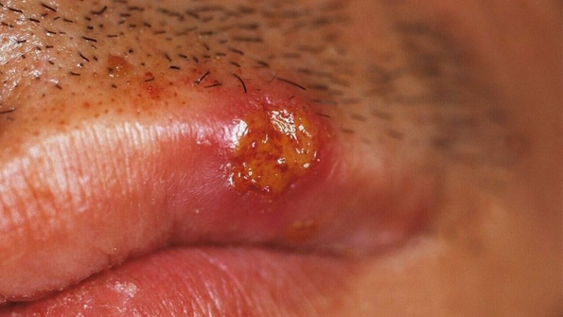 Các vết loét có viền đỏ xung quanh ở người bệnh hạ cam mềm