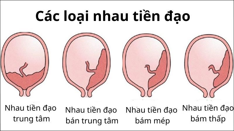 Nhau tiền đạo được chia thành 4 loại