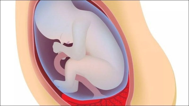 Nhau tiền đạo có thể gây sinh khó do ngôi thai bất thường